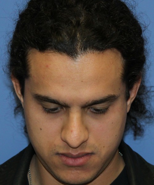 Rhinoplasty 4468 – Click HERE for more views before photo. Individual results may vary.