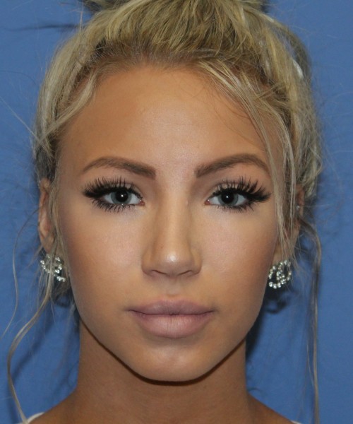 Rhinoplasty 4483 – Click HERE for more views after photo. Individual results may vary.
