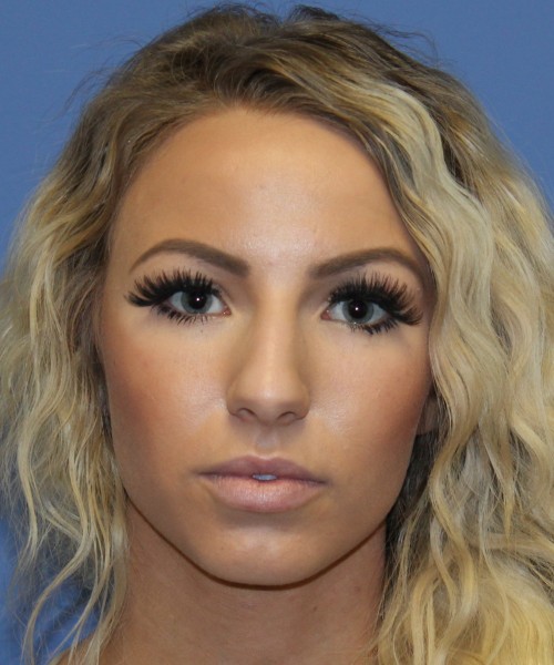Rhinoplasty 4483 – Click HERE for more views before photo. Individual results may vary.
