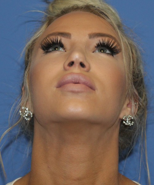 Rhinoplasty 4483 – Click HERE for more views after photo. Individual results may vary.