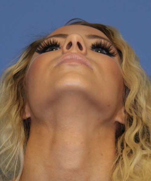 Rhinoplasty 4483 – Click HERE for more views before photo. Individual results may vary.