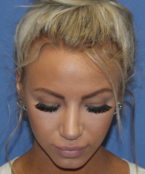 Rhinoplasty 4483 – Click HERE for more views after photo. Individual results may vary.
