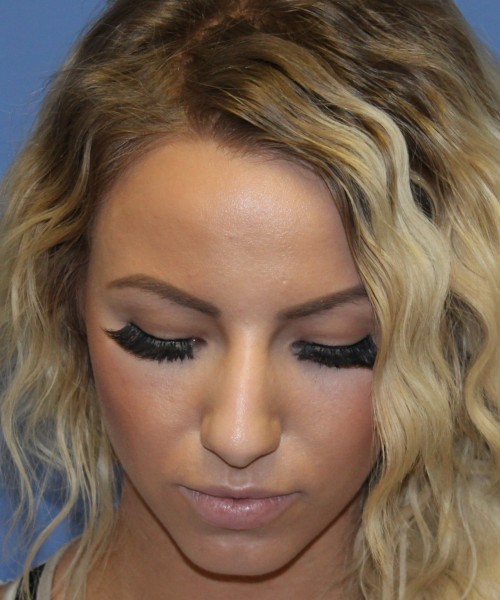 Rhinoplasty 4483 – Click HERE for more views before photo. Individual results may vary.