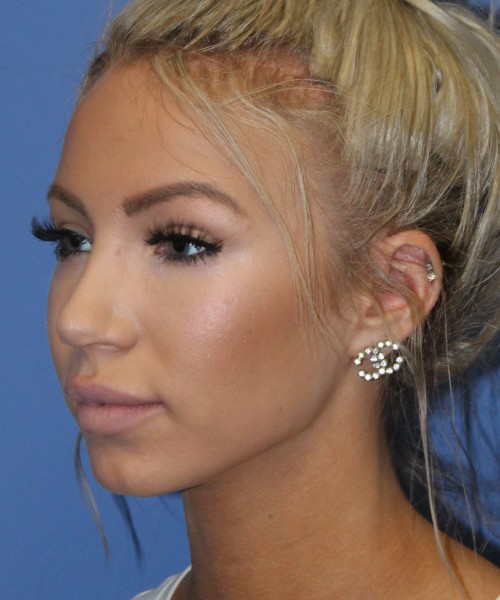 Rhinoplasty 4483 – Click HERE for more views after photo. Individual results may vary.