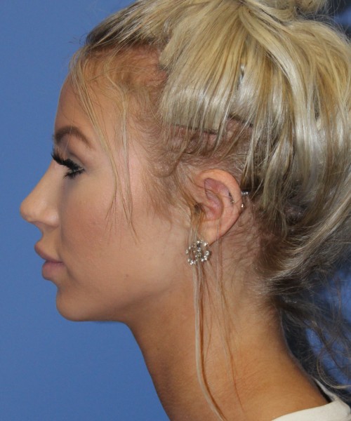 Rhinoplasty 4483 – Click HERE for more views after photo. Individual results may vary.