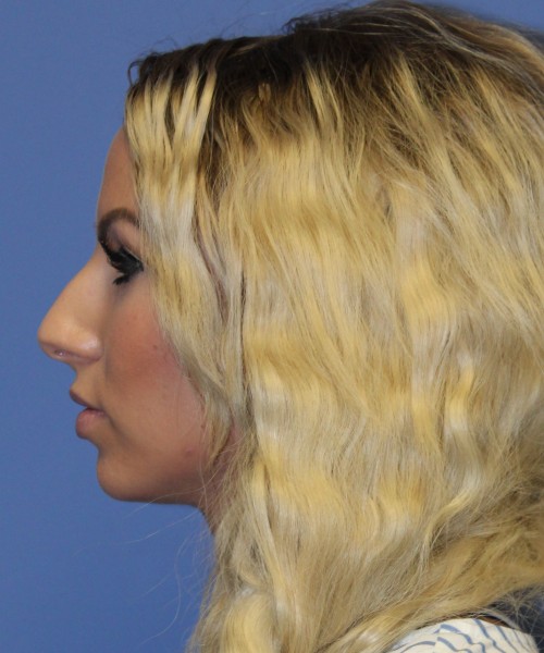 Rhinoplasty 4483 – Click HERE for more views before photo. Individual results may vary.