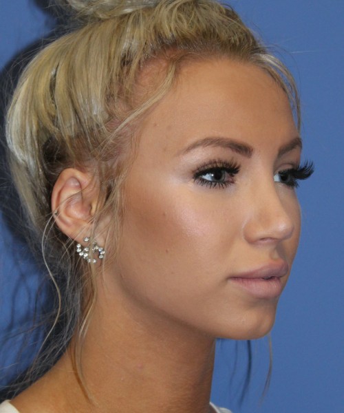 Rhinoplasty 4483 – Click HERE for more views after photo. Individual results may vary.