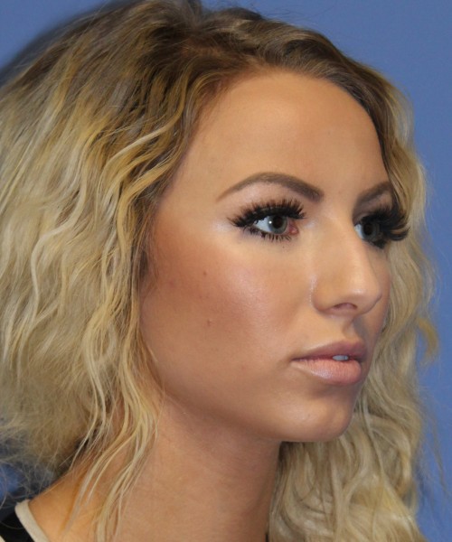 Rhinoplasty 4483 – Click HERE for more views before photo. Individual results may vary.