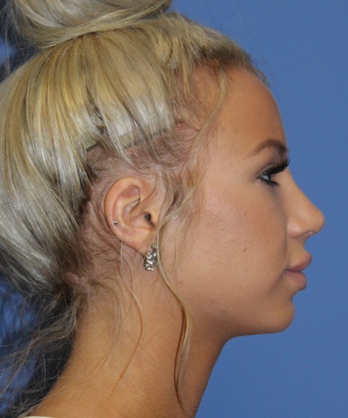 Rhinoplasty 4483 – Click HERE for more views after photo. Individual results may vary.