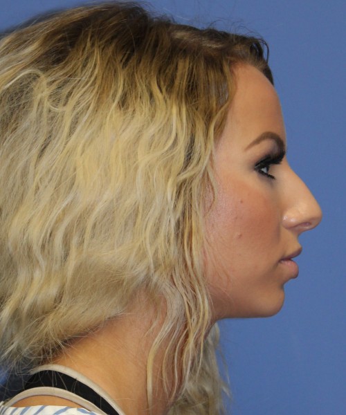 Rhinoplasty 4483 – Click HERE for more views before photo. Individual results may vary.