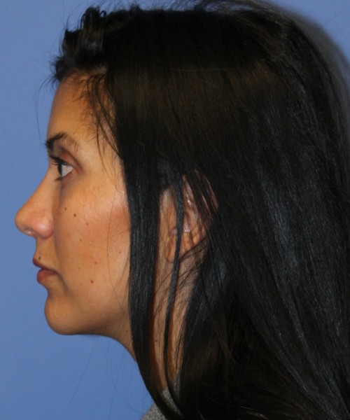 Dorsal Rhinoplasty 4498 – Click HERE for more views after photo. Individual results may vary.