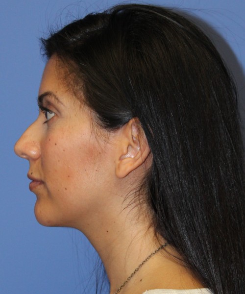 Dorsal Rhinoplasty 4498 – Click HERE for more views before photo. Individual results may vary.