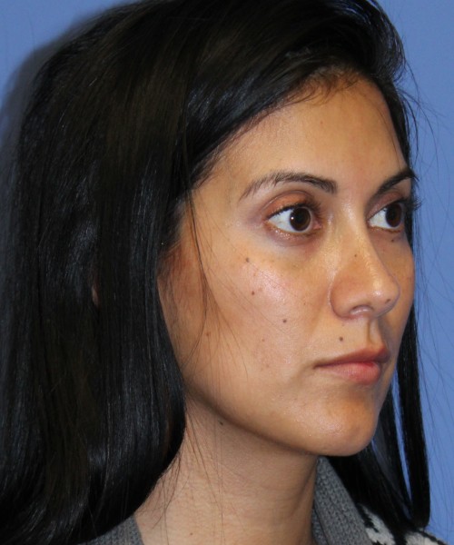 Dorsal Rhinoplasty 4498 – Click HERE for more views after photo. Individual results may vary.