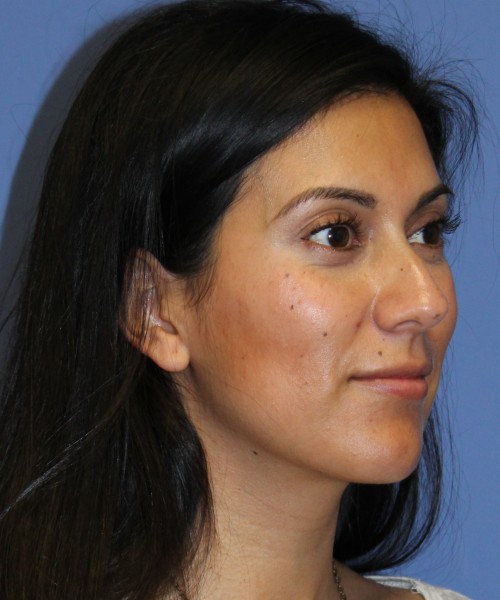Dorsal Rhinoplasty 4498 – Click HERE for more views before photo. Individual results may vary.