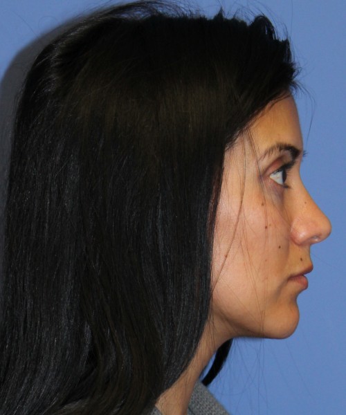 Dorsal Rhinoplasty 4498 – Click HERE for more views after photo. Individual results may vary.