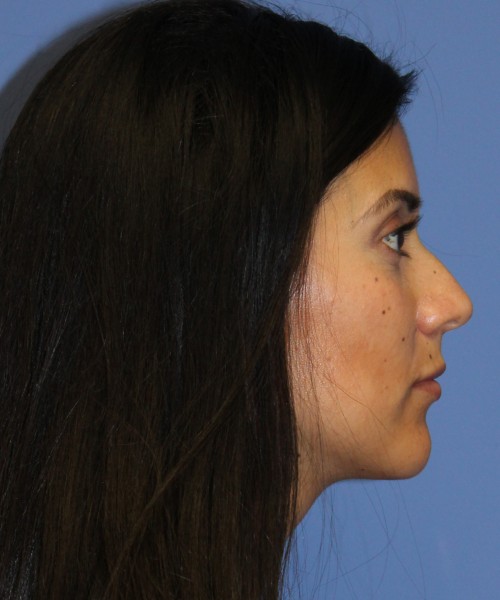 Dorsal Rhinoplasty 4498 – Click HERE for more views before photo. Individual results may vary.