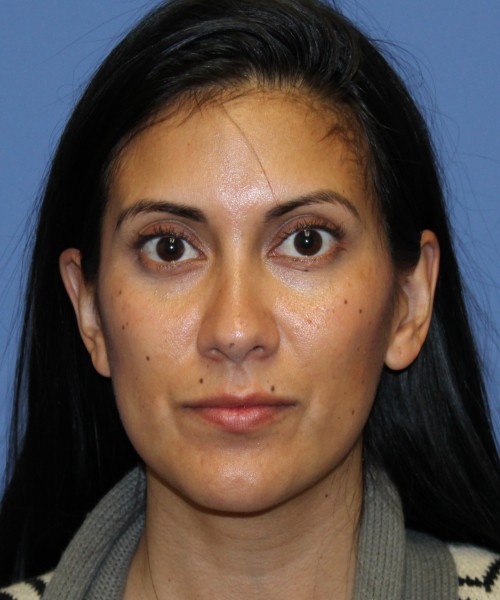 Dorsal Rhinoplasty 4498 – Click HERE for more views after photo. Individual results may vary.