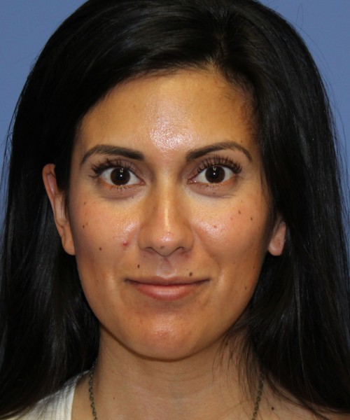 Dorsal Rhinoplasty 4498 – Click HERE for more views before photo. Individual results may vary.