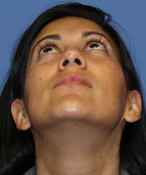 Dorsal Rhinoplasty 4498 – Click HERE for more views after photo. Individual results may vary.