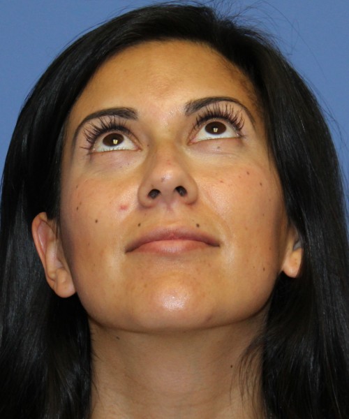 Dorsal Rhinoplasty 4498 – Click HERE for more views before photo. Individual results may vary.
