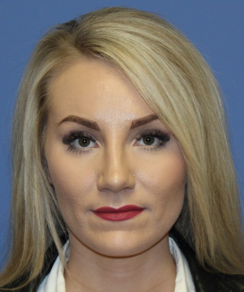 Rhinoplasty 4513 – Click HERE for more views after photo. Individual results may vary.