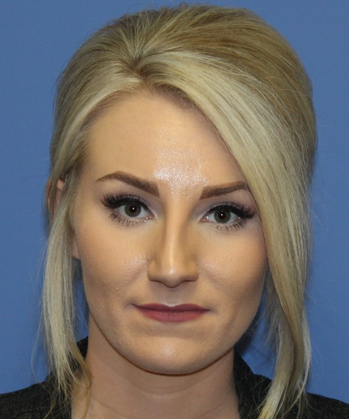 Rhinoplasty 4513 – Click HERE for more views before photo. Individual results may vary.