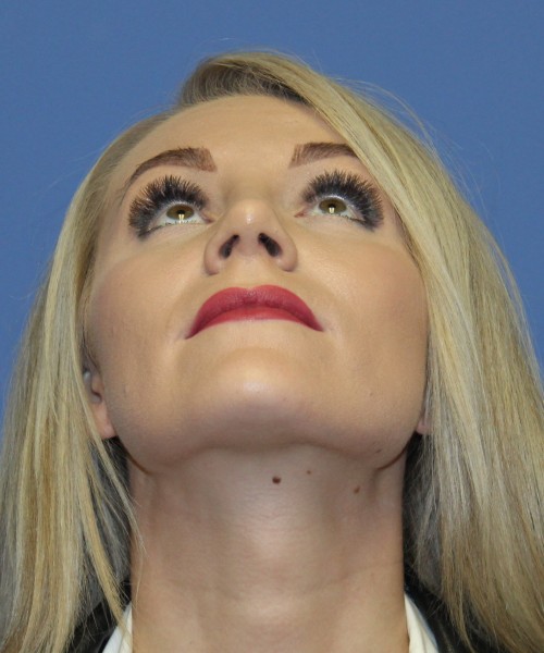 Rhinoplasty 4513 – Click HERE for more views after photo. Individual results may vary.