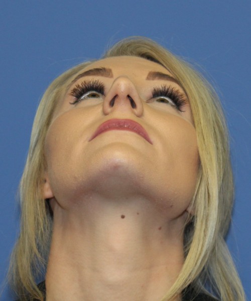 Rhinoplasty 4513 – Click HERE for more views before photo. Individual results may vary.