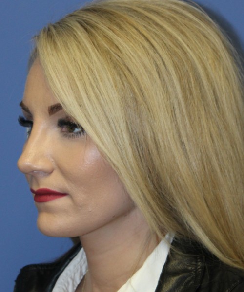 Rhinoplasty 4513 – Click HERE for more views after photo. Individual results may vary.