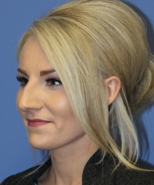 Rhinoplasty 4513 – Click HERE for more views before photo. Individual results may vary.