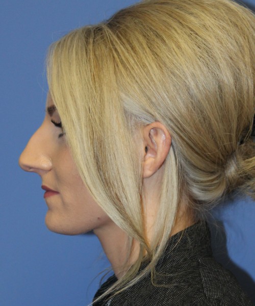 Rhinoplasty 4513 – Click HERE for more views before photo. Individual results may vary.
