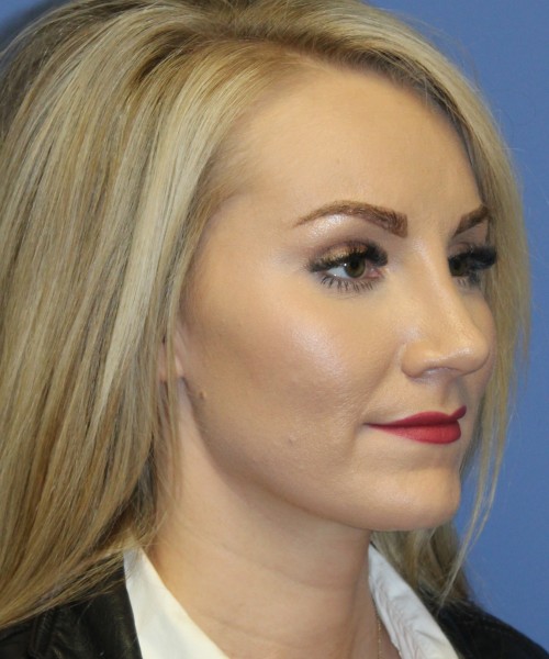 Rhinoplasty 4513 – Click HERE for more views after photo. Individual results may vary.