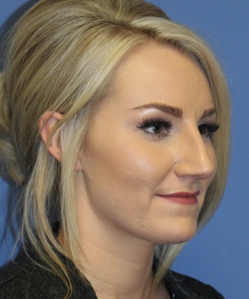 Rhinoplasty 4513 – Click HERE for more views before photo. Individual results may vary.
