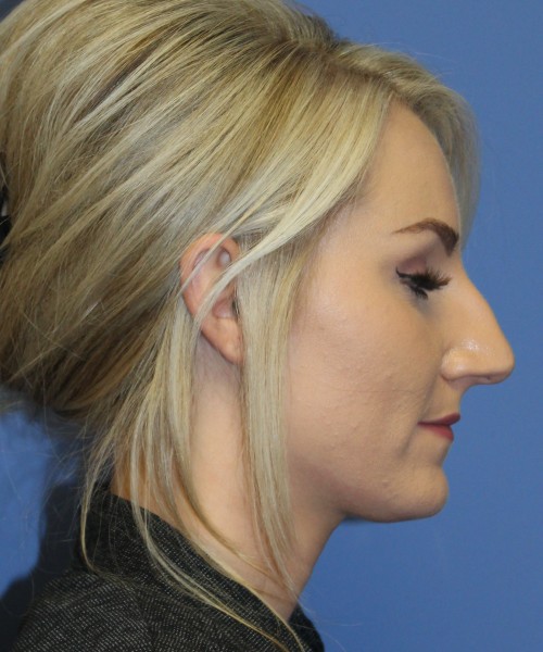 Rhinoplasty 4513 – Click HERE for more views before photo. Individual results may vary.
