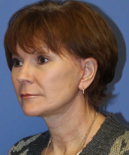 Facelift, Browlift, Blepharoplasty, SMAS Lip Augmentation 4514 – Click HERE for more views after photo. Individual results may vary.