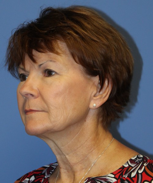 Facelift, Browlift, Blepharoplasty, SMAS Lip Augmentation 4514 – Click HERE for more views before photo. Individual results may vary.