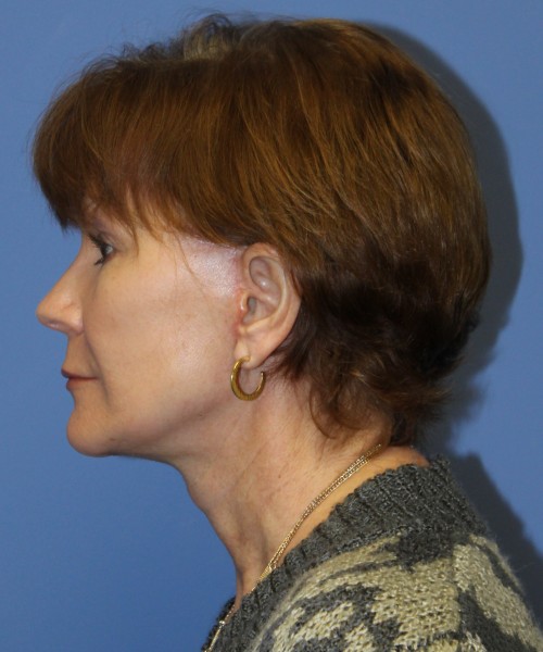 Facelift, Browlift, Blepharoplasty, SMAS Lip Augmentation 4514 – Click HERE for more views after photo. Individual results may vary.
