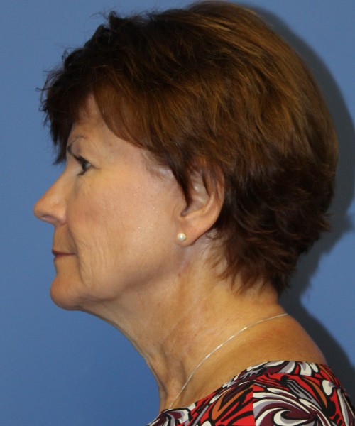 Facelift, Browlift, Blepharoplasty, SMAS Lip Augmentation 4514 – Click HERE for more views before photo. Individual results may vary.