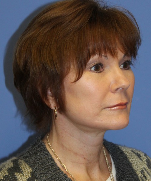 Facelift, Browlift, Blepharoplasty, SMAS Lip Augmentation 4514 – Click HERE for more views after photo. Individual results may vary.