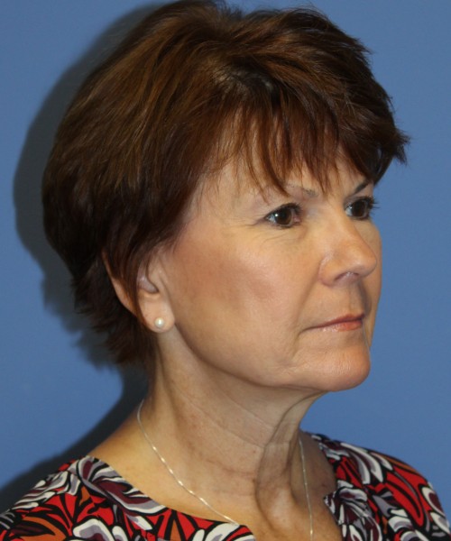 Facelift, Browlift, Blepharoplasty, SMAS Lip Augmentation 4514 – Click HERE for more views before photo. Individual results may vary.