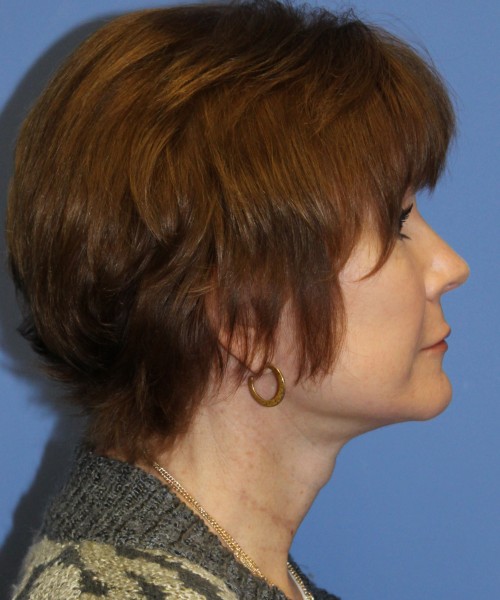 Facelift, Browlift, Blepharoplasty, SMAS Lip Augmentation 4514 – Click HERE for more views after photo. Individual results may vary.