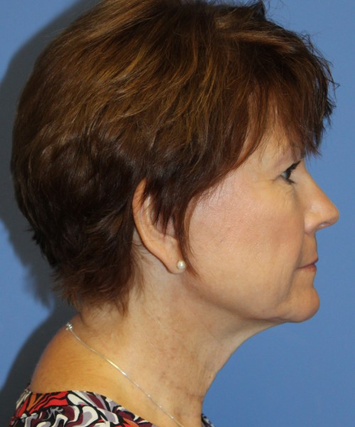 Facelift, Browlift, Blepharoplasty, SMAS Lip Augmentation 4514 – Click HERE for more views before photo. Individual results may vary.