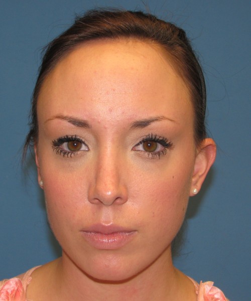 Rhinoplasty Case 0669 Click HERE for more views after photo. Individual results may vary.