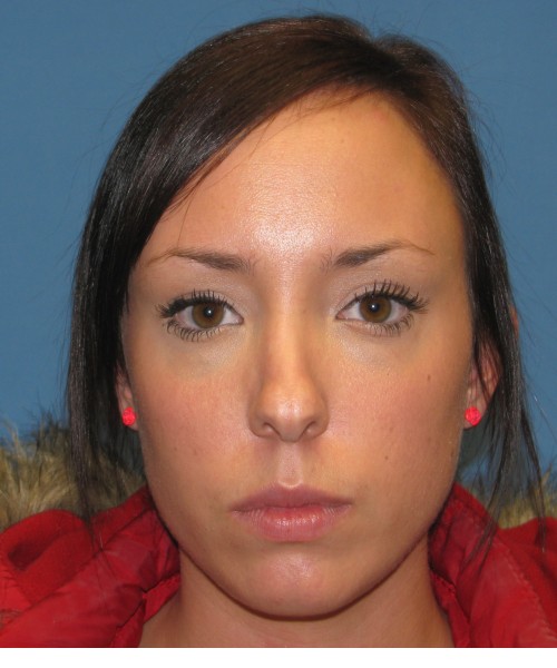 Rhinoplasty Case 0669 Click HERE for more views before photo. Individual results may vary.