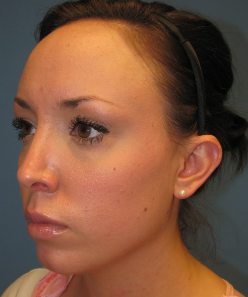 Rhinoplasty Case 0669 Click HERE for more views after photo. Individual results may vary.