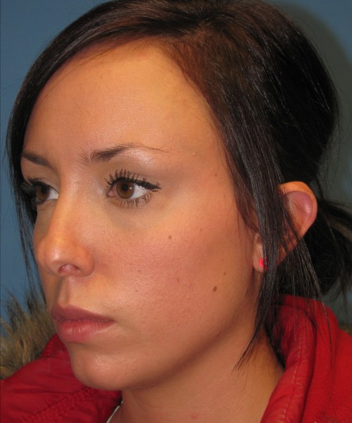 Rhinoplasty Case 0669 Click HERE for more views before photo. Individual results may vary.