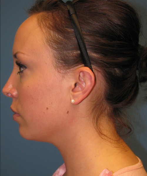 Rhinoplasty Case 0669 Click HERE for more views after photo. Individual results may vary.