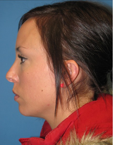 Rhinoplasty Case 0669 Click HERE for more views before photo. Individual results may vary.