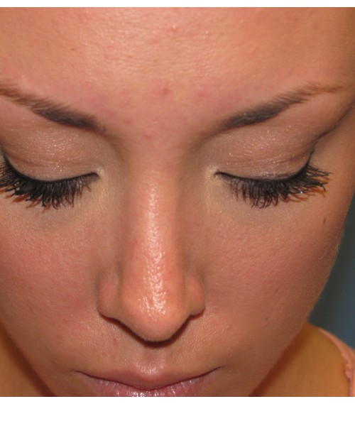 Rhinoplasty Case 0669 Click HERE for more views after photo. Individual results may vary.