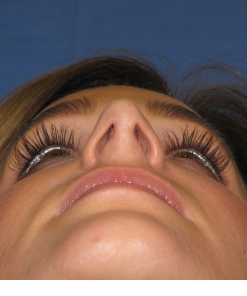 Rhinoplasty Case 7017 Click HERE for more views after photo. Individual results may vary.